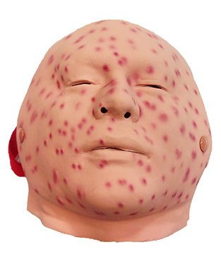 Smallpox Moulage, 2nd-3rd Day, 800-627