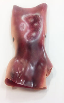 Burn Forearm 2nd & 3rd Degree, 800-6802