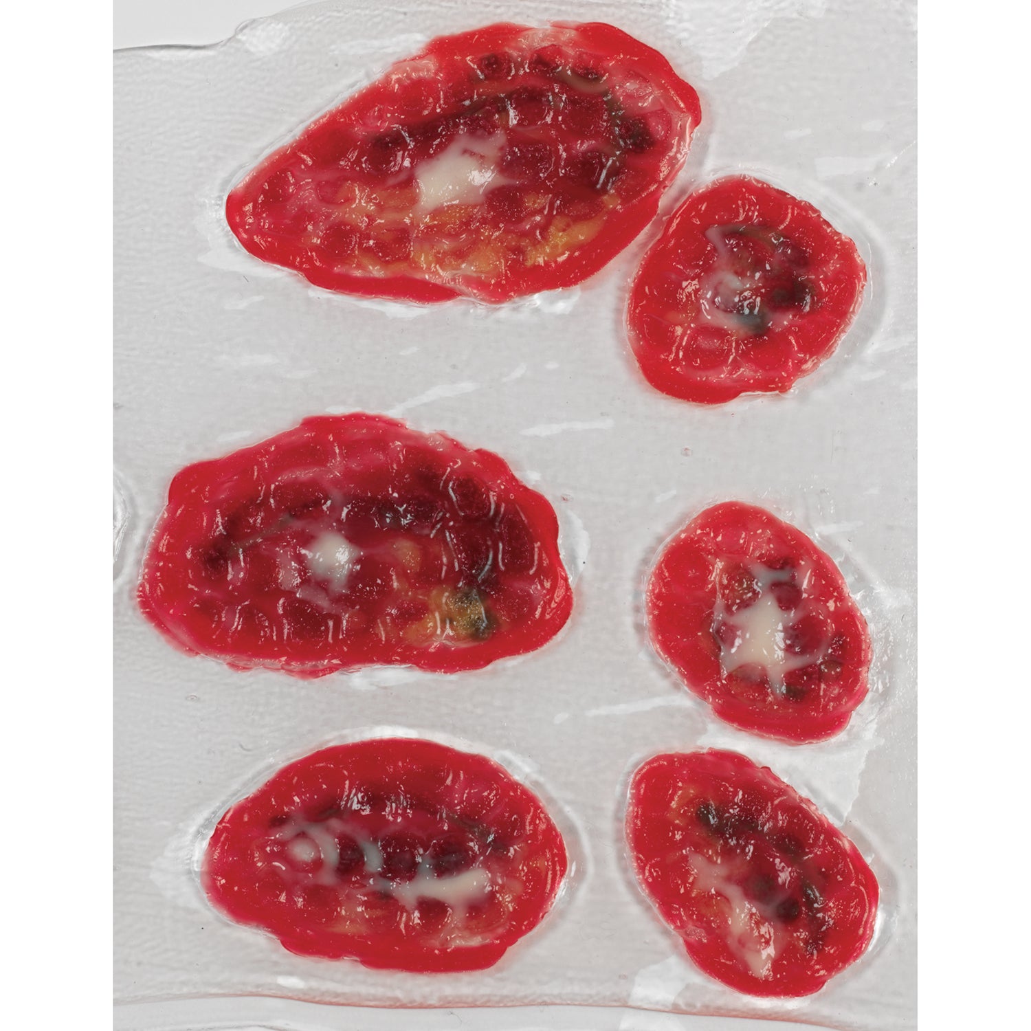 Life/Form Venous Stasis Ulcer, LF00792