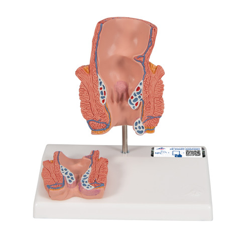 A vivid hemorrhoid model designed to educate patients and students about hemorrhoids. The anatomy model is a life-size frontal section of the rectum as well as a smaller relief on a pedestal. In addition to the anatomical structures of the rectum (sphincter, mucous membrane, venous plexus), the model shows internal hemorrhoids during stage I and II as well as external hemorrhoids. The relief exhibit shows hemorrhoids during stage III and IV. The high quality anatomy hemorrhoid model is mounted on base.