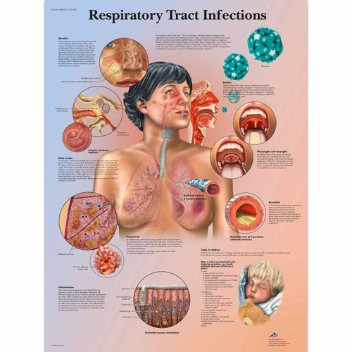 Respiratory Tract Infections Chart