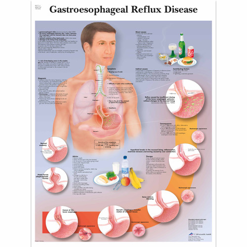 Gastroesophageal Reflux Disease Chart (GERD)