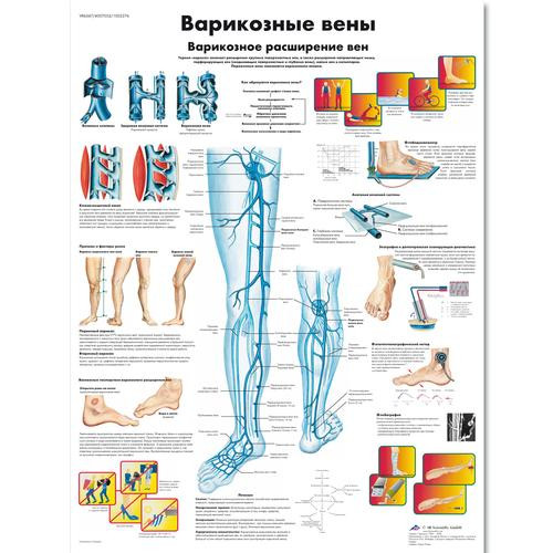 Varicose Veins  Chart