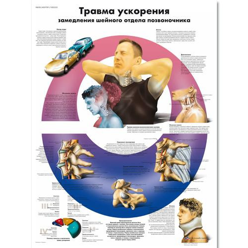 Acceleration Injury to the Cervical Spine  Chart