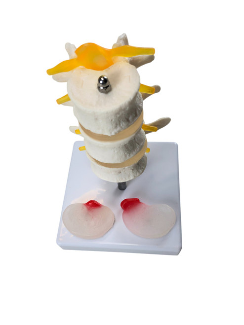 Three Lumbar Vertebrae with Herniation and Prolapse Model MG19857U