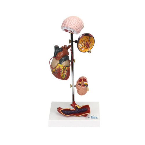 Effects of Arterial Hypertension Model, 5 Parts MG22747U