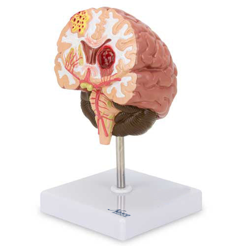 Brain Section with Pathology Model MG31100U