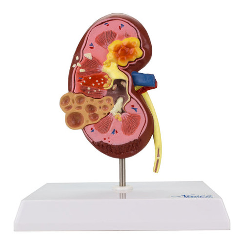 Kidney with Pathology Model, 2-1/2X Enlarged MG31019U