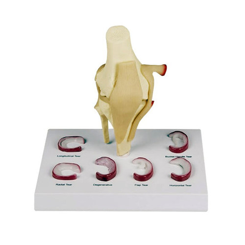 Meniscus Knee with 6 Tears Model MG35506U