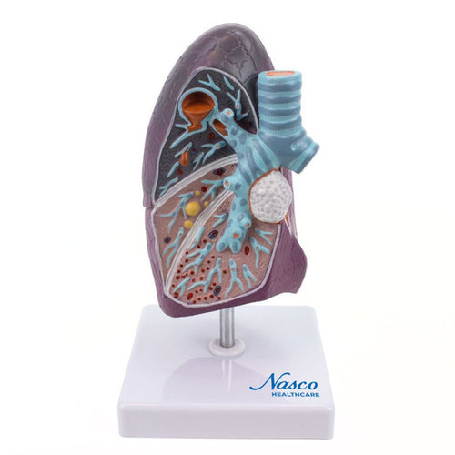 Lung with Pathology Model, 1.5X Enlarged MG30885U