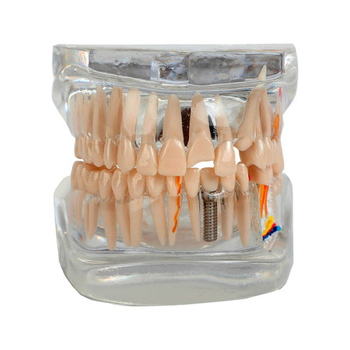 Translucent Adult Dentition Normal and Pathology Model MG38398U