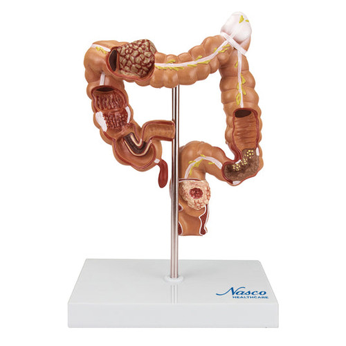 Intestinal Pathologies of Colon & Rectum Model MG35589U