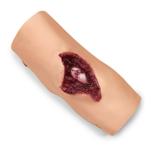 Compound Fracture - Humerus no Pump Assembly 800-6816NPU