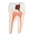 This 2 part lower twin-root molar has a longitudinal section. The Lower Twin-Root Molar displays cavities. The tooth is a accurate representation of adult dentition.