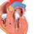 This unique heart model shows the long-term effects of increased heart activity due to high blood pressure. The muscular wall of the left heart ventricle is considerably thickened and the tip of the heart is visibly rounded off. Highly detailed 2-part heart at a price you will love. The front heart wall is detachable to reveal the chambers and valves inside. The heart is just slightly smaller than life-size with exquisite anatomical detail throughout. Heart on removable stand.