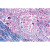 1(e). Parenchymatous and fatty degeneration of liver 2(e). Hemosiderosis of liver 3(e). Glycogenosis of liver 4(e). Pigmentary cirrhosis of liver 5(e). Necrotic esophagitis 6(e). Foreign body granuloma with hemosiderin and giant cells 7(e). Tonsillitis 8(e). Liver cirrhosis Injury of circulatory organs and blood-forming organs 9(e). Adiposis of heart 10(e). Cardiac callosity 11(e). Myocarditis chronica acute recidivans 12(e).