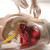This unique model of a human buttock has a special two-in-one function: On the right hand side, the anatomy of the bones, ilium crista, greater trochannter, m. gluteus medius, nerves and veins can be studied through the transparent outer structure.