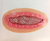Skin Graft 6"
