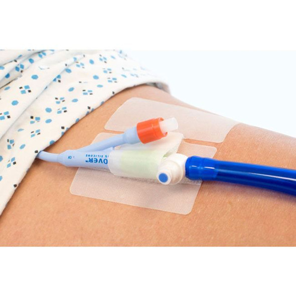 Cath Secure Lock - Multi-Purpose Tube Holder In Use View
