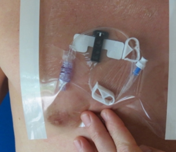 Wound Protector HydroSeal 9 X 9 Inch in use Wound Protector HydroSeal 9 X 9 Inch in use