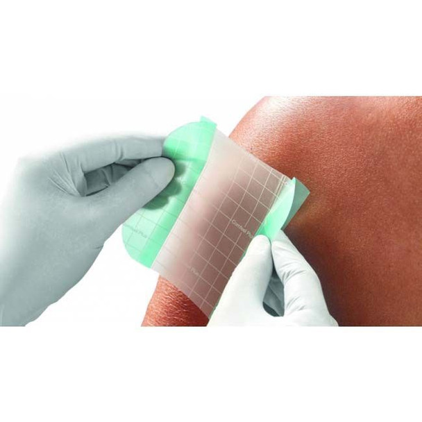 Comfeel Plus - Clear Hydrocolloid Wound Dressing In Use View