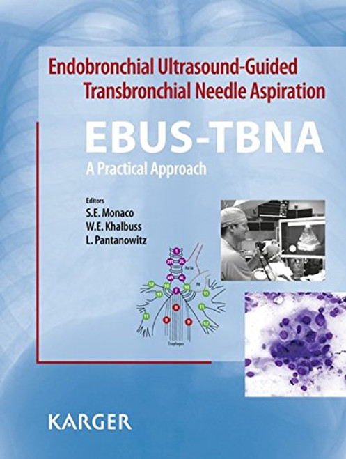 Endobronchial Ultrasound Guided Transbronchial Needle Aspiration (EBUS-TBNA): Cytomorphology and Atlas: A Practical Approach
