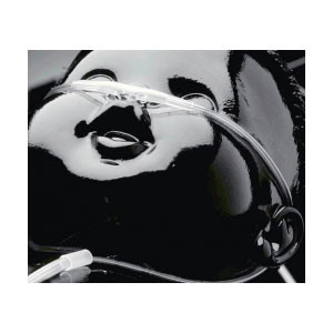 CANNULAS OXYGEN NASAL CURVED TIP PEDIATRIC CLEAR CRIMP RESIST W/O TUBING INTERMEDIATE SUNMED (50/CS) [157-1662-0-50]