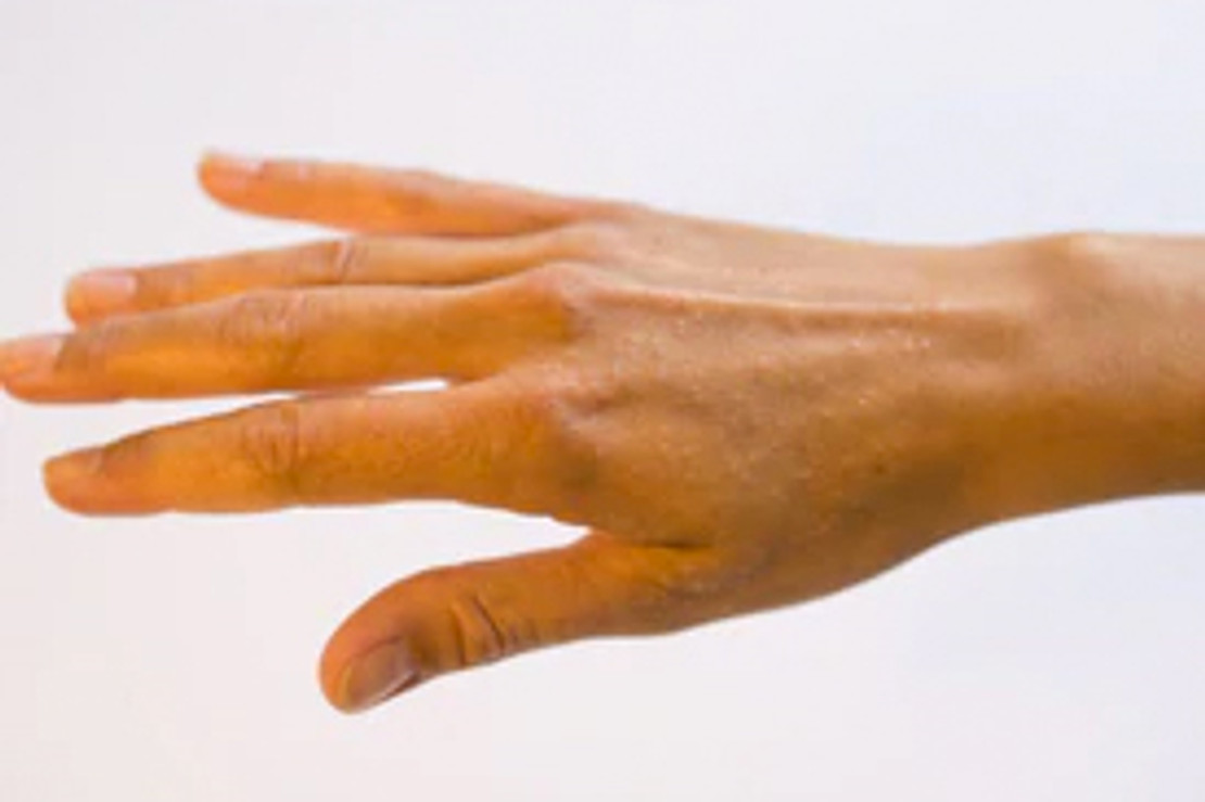 The Different Types of Eczema The Different Types of Eczema