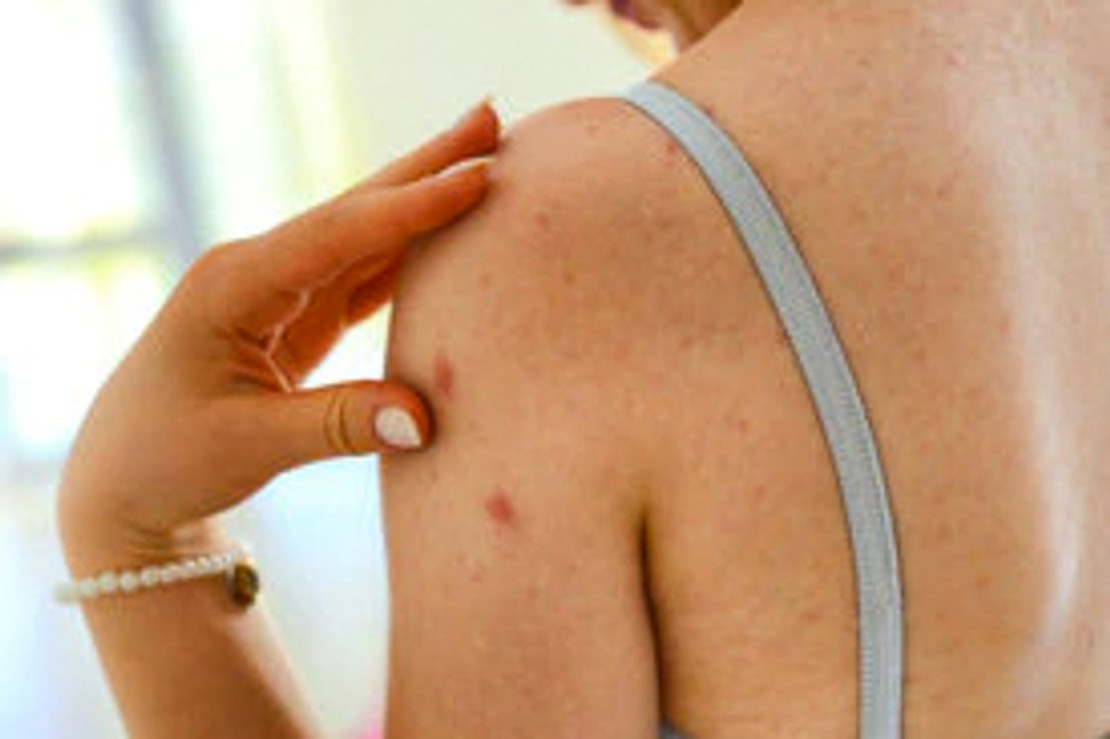 What You Need to Know About Eczema What You Need to Know About Eczema