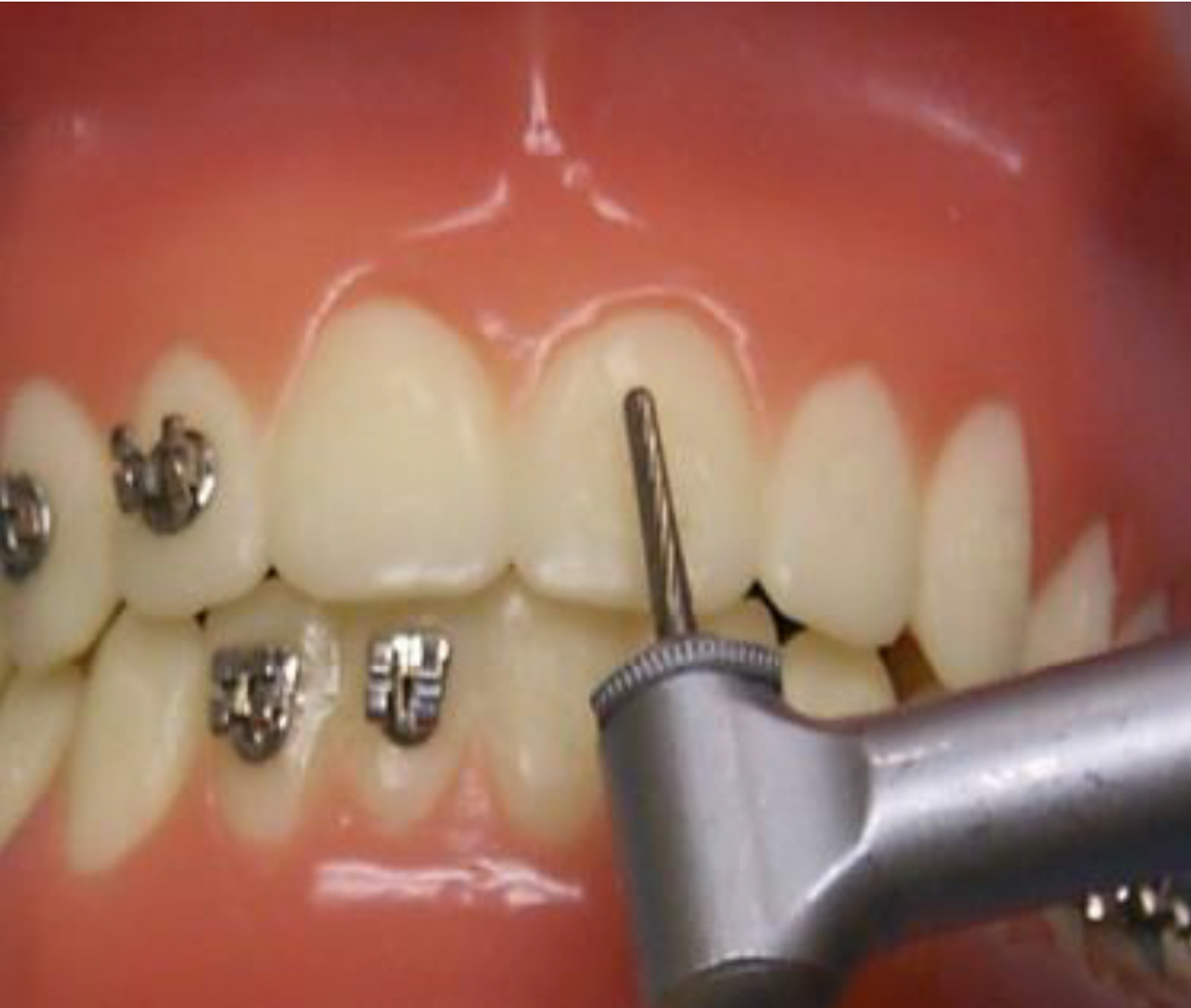 Portable Handpiece, 25K