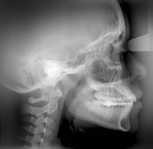 Film, Cephalometric  8" x 10"