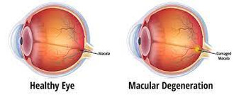 ​Understanding Macular Degeneration
