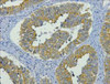 IHC staining of human colon cancer tissue, diluted at 1:200.