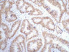 IHC staining of Human colon cancer tissue paraffin-embedded, diluted at 1:200.