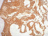 IHC staining of human gullet cancer tissue, diluted at 1:200.