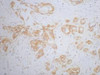 IHC staining of human breast cancer tissue, diluted at 1:200.