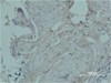 Immunohistochemical analysis of paraffin-embedded human breast caricnoma using PR Monoclonal Antibody.