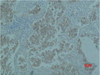 Immunohistochemical analysis of paraffin-embedded Human Lung caricnoma using Catenin-β Monoclonal Antibody.