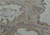 Immunohistochemical analysis of paraffin-embedded Human Lung Caricnoma using Phosphoserine Mouse mAb diluted at 1:200.