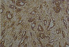 Immunohistochemical analysis of paraffin-embedded Human Breast Caricnoma using Phosphoserine Mouse mAb diluted at 1:200.