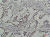 Immunohistochemical analysis of paraffin-embedded Human Breast Caricnoma using Phosphotyrosine Mouse mAb diluted at 1:200.