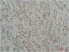 Immunohistochemical analysis of paraffin-embedded Human Breast Carcinoma using TBP/TATA Binding Protein（mAb diluted at 1:200.