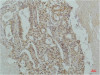 Immunohistochemical analysis of paraffin-embedded Human Lung Carcinoma using IκB β (mAb diluted at 1:200.