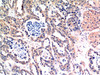 Immunohistochemical analysis of paraffin-embedded Human Breast Carcinoma Tissue using Bax Mouse mAb diluted at 1:200.