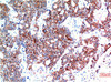 Immunohistochemical analysis of paraffin-embedded Human Breast Carcinoma Tissue using Beclin-1 Mouse mAb diluted at 1:200.