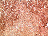 Immunohistochemical analysis of paraffin-embedded Human Lung Carcinoma Tissue using P38 Mouse mAb diluted at 1:200.