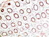 Immunohistochemical analysis of paraffin-embedded Human Colon Carcinoma Tissue using Collagen I Mouse mAb diluted at 1:200.