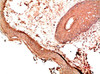 Immunohistochemical analysis of paraffin-embedded Human skin Carcinoma Tissue using Collagen I Mouse mAb diluted at 1:200.