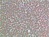 Immunohistochemical analysis of paraffin-embedded Human Liver Carcinoma Tissue using TTR Mouse mAb diluted at 1:200.