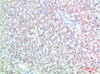 Immunohistochemical analysis of paraffin-embedded Human Liver Carcinoma Tissue using TTR Mouse mAb diluted at 1:200.